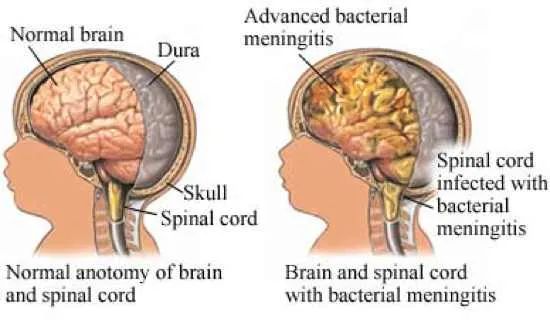 Meningitis