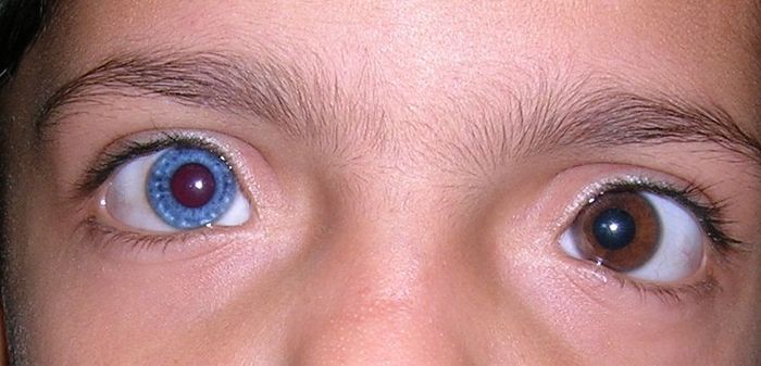 Heterochromia_Iridis