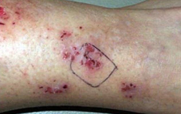 1-morgellons-disease