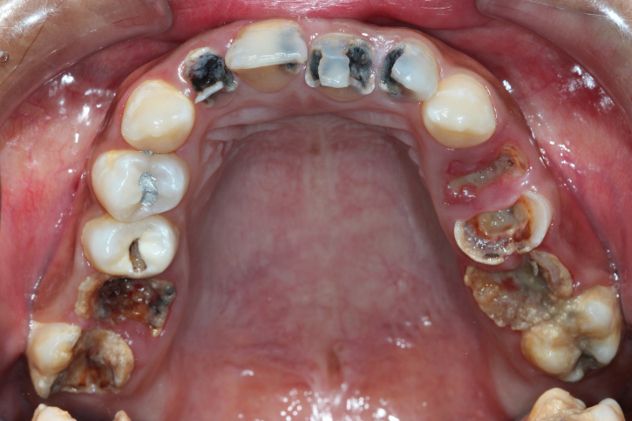 decayteeth