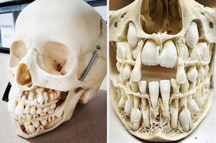 A human skull displaying multiple rows of teeth.