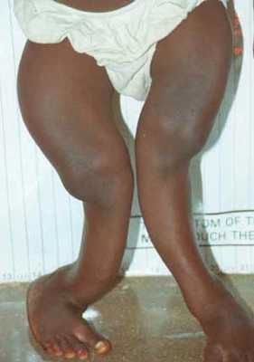 Rickets