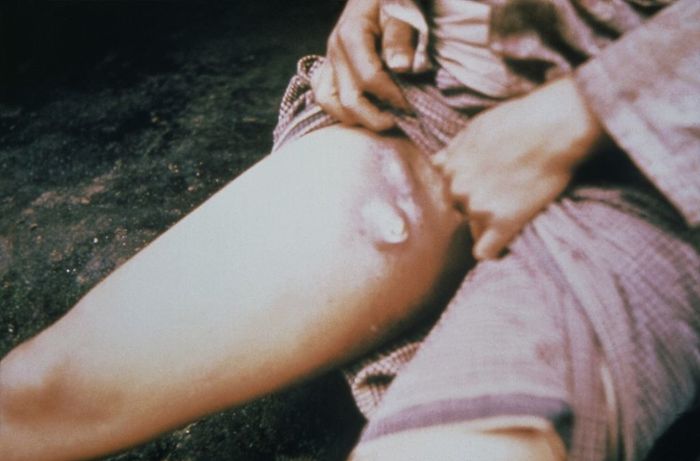 Buboes on a plague-infected patient