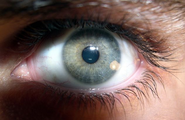 eye