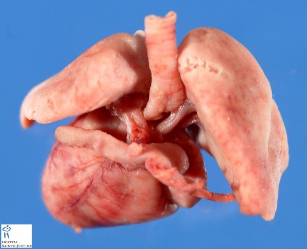 Situs Inversus is a rare and unusual condition where the organs in the abdomen and thorax are arranged in reverse. In this condition, the heart is typically located on the right side of the chest, and organs like the stomach and spleen switch places with the liver and gall bladder. The intestines and other organs may also be misplaced. Although this condition is uncommon, occurring in less than 1 in 10,000 individuals, many people live without ever realizing they have it, as it is often discovered incidentally by a medical professional. External appearances remain normal, but individuals with Situs Inversus may carry a special medical note to avoid surgical mistakes in an emergency situation.