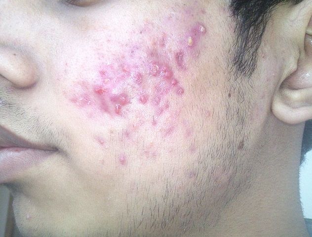 I_have_to_much_pimple_what_should_I_do_2013-12-20_12-57