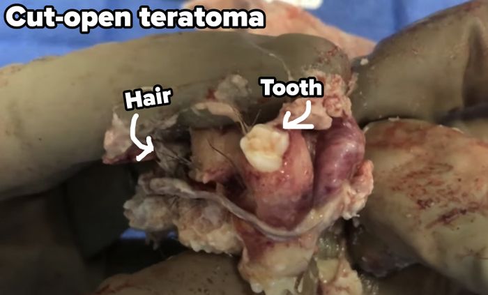 A teratoma containing teeth and hair.