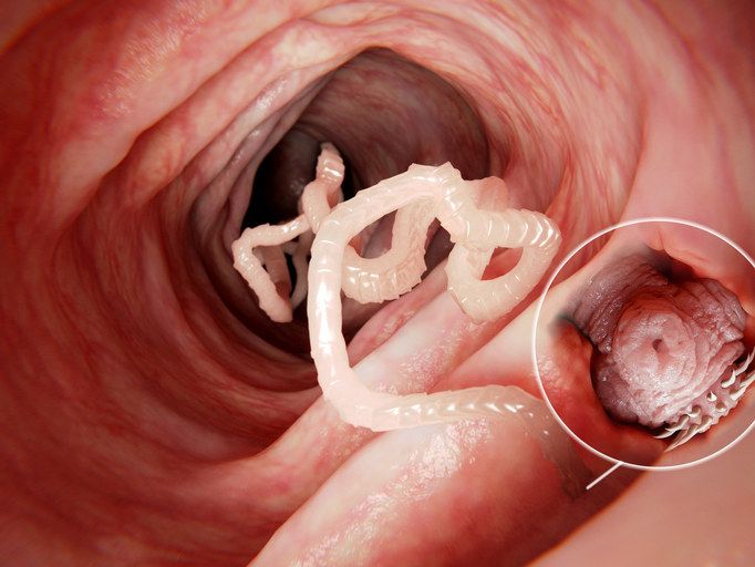 Tapeworms inside a body.
