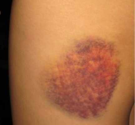Bruise-300X277