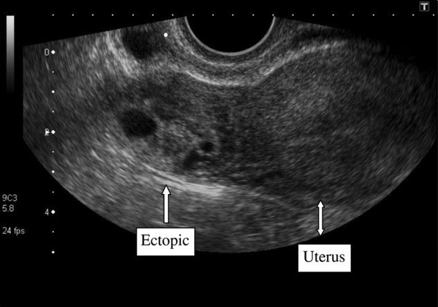 Ectopic
