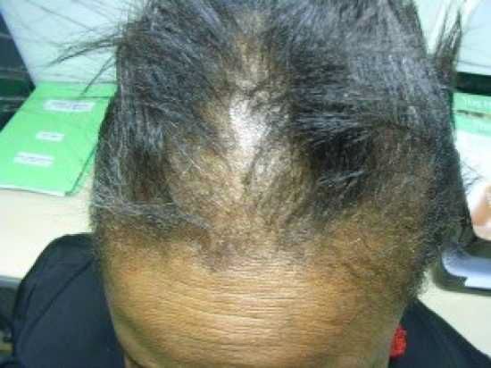Biotin-Defieciency-2