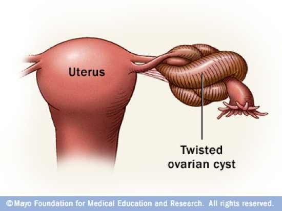 W7 Ovarian Torsion