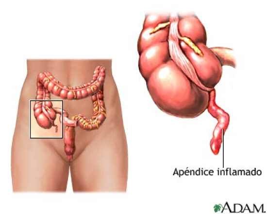 Peritonitis