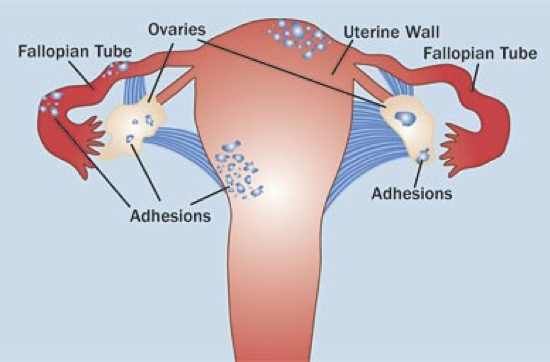Endometriosis-Fig-2Col