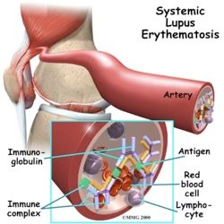 Arthritis Lupus Lupus01