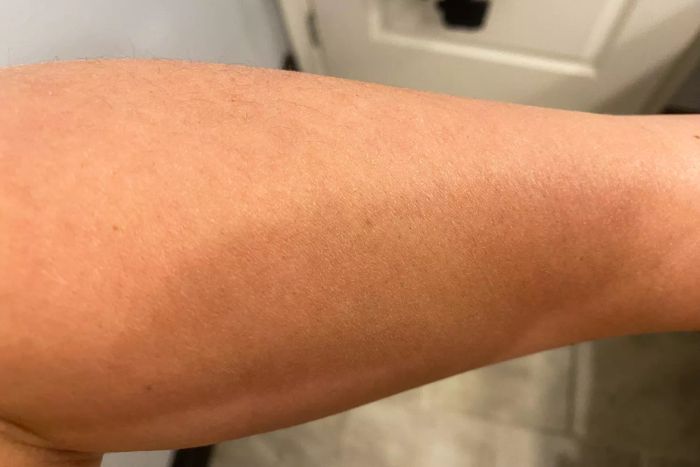 A person's arm prior to using La Roche-Posay Lipikar Wash AP+ Moisturizing Body & Face Wash
