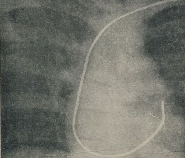 catheter