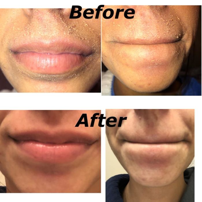A reviewer’s before and after photos highlighting their previously dry skin that is now moisturized and free of flakes