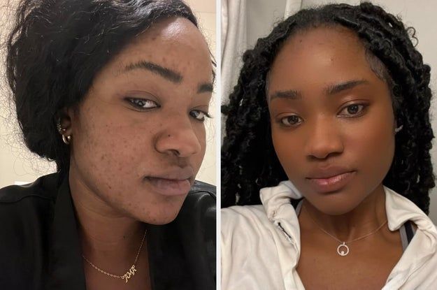 The reviewer’s before and after photos show visibly more hydrated and radiant skin after using the serum