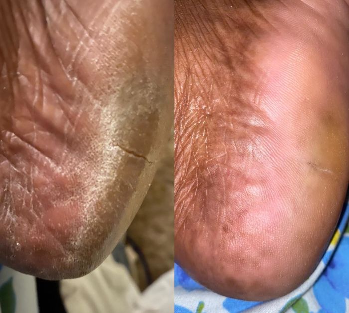 A reviewer shows a before photo of their cracked heel next to an after photo, where much of the dead skin has been removed, revealing softer, pinker heels