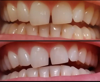 Before-and-after photos showing the effectiveness of the teeth whitening treatment