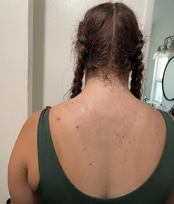 The reviewer showcasing their clear back after using the wash