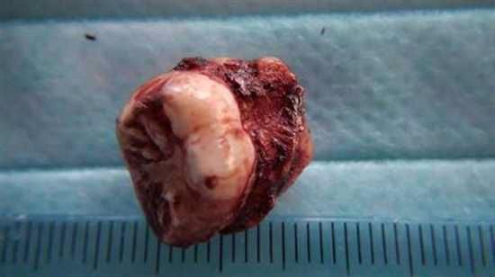 Tooth Removed From Nose-Tury