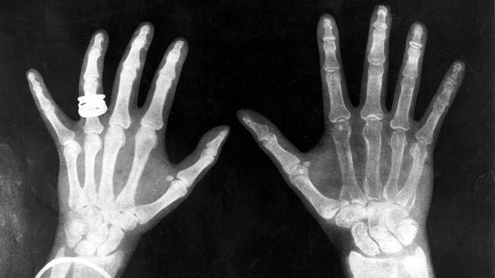 X-rays of King George and Queen Mary
