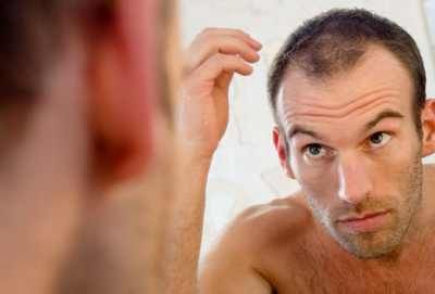 Male Hair Loss