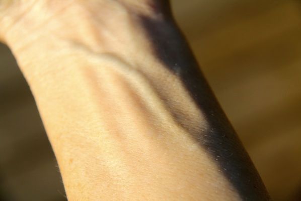 Veins appearing blue