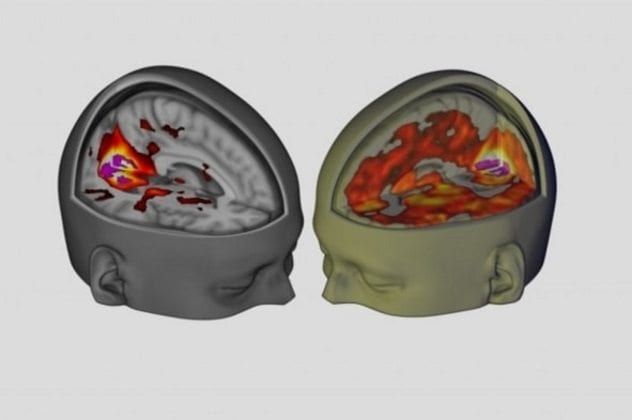 Comparing Normal and LSD-Affected Brains