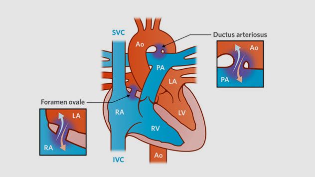 1a-normal-newborn-heart
