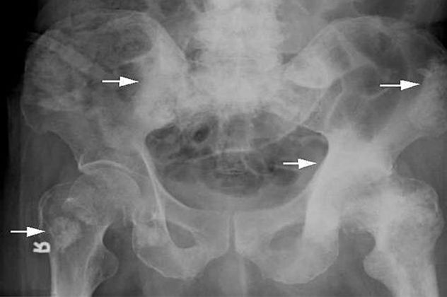 8prostatecancer