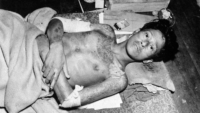 victim of the Nagasaki bombing