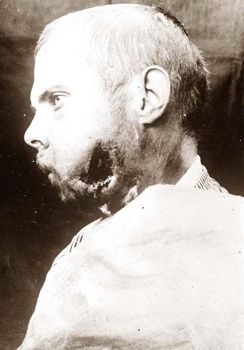 Wounded-World-War-I-001