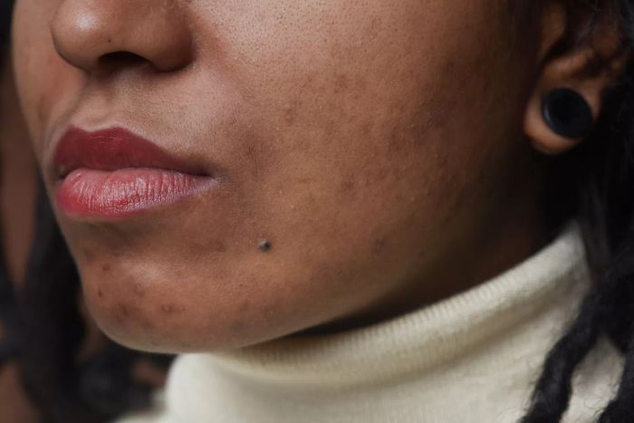Close-up portrait of a real African American woman with post-acne scars and skin imperfections