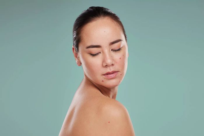 woman displaying red moles