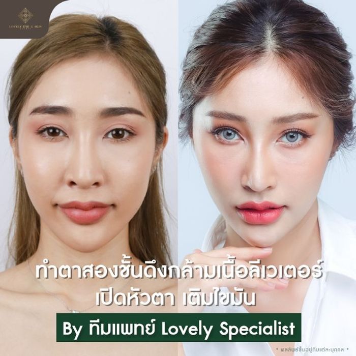 สำรวจเคสศัลยกรรมตาสวยสายฝอของสาวงาม 3 สไตล์ที่ Lovely Eye & Skin Clinic