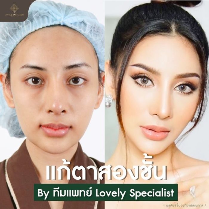 สำรวจเคสศัลยกรรมตาสวยสายฝอในสไตล์ต่างๆ ของสาวงาม 3 สไตล์ที่ Lovely Eye & Skin Clinic