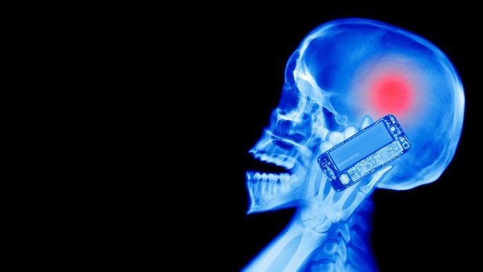 X-ray of a Person Using a Mobile Device with a Brain Tumor Induced by Radiation