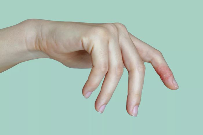 Atopic-Dermatitis-GettyImages-1226169516