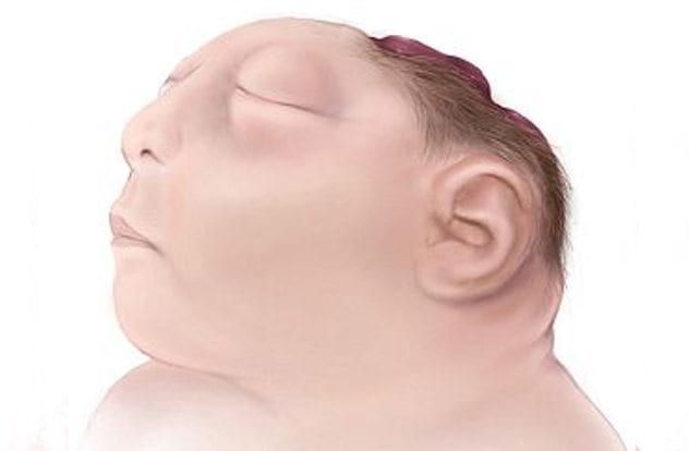 anencephaly