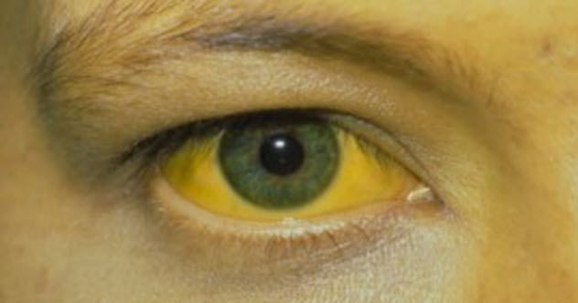7b-yellow-fever-feature