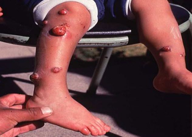8-carrions-disease