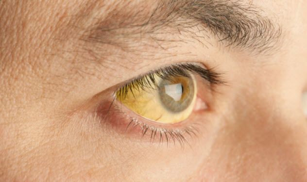 9-jaundice_000020563599_Small