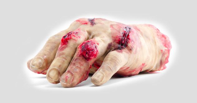 3e-amputated-hand_000042822714_Small