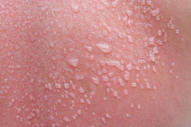 Skin Blisters