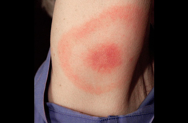 rash
