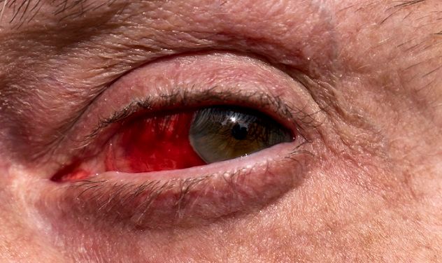 Infected Eye