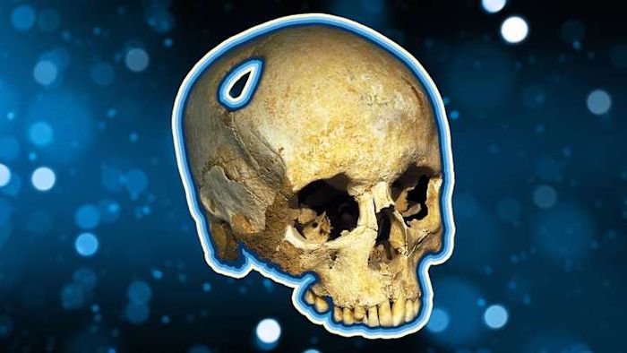 A 5,500-year-old skull of a woman, showing signs of trepanation, now rests in a Swiss museum.
